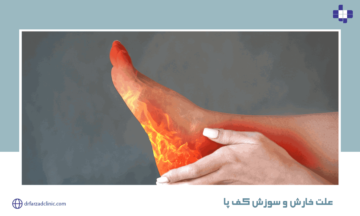 علت خارش و سوزش کف پا